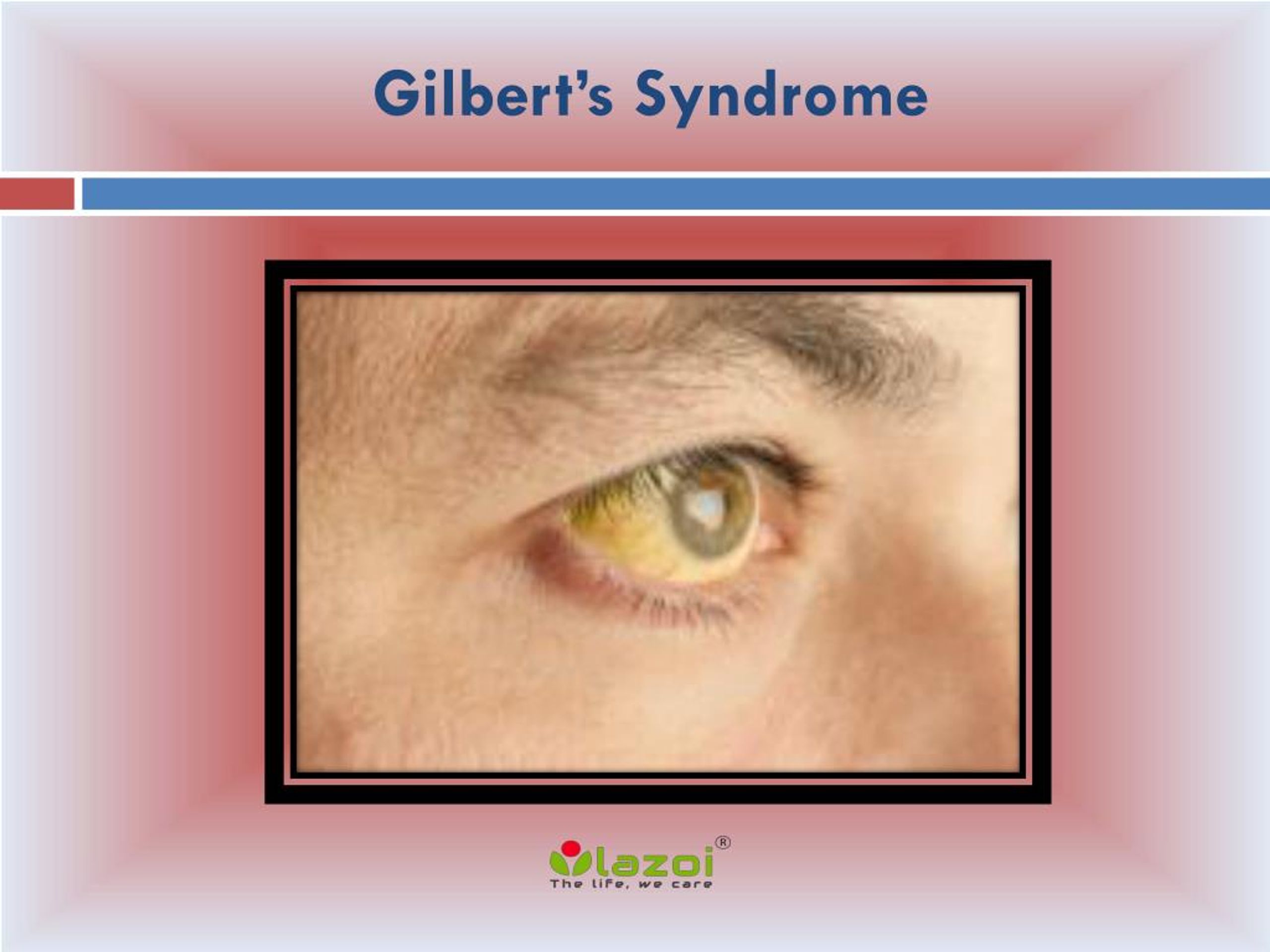 Синдром жильбера что это такое. Склеры при синдроме Жильбера. Иктеричность склер при синдроме Жильбера.