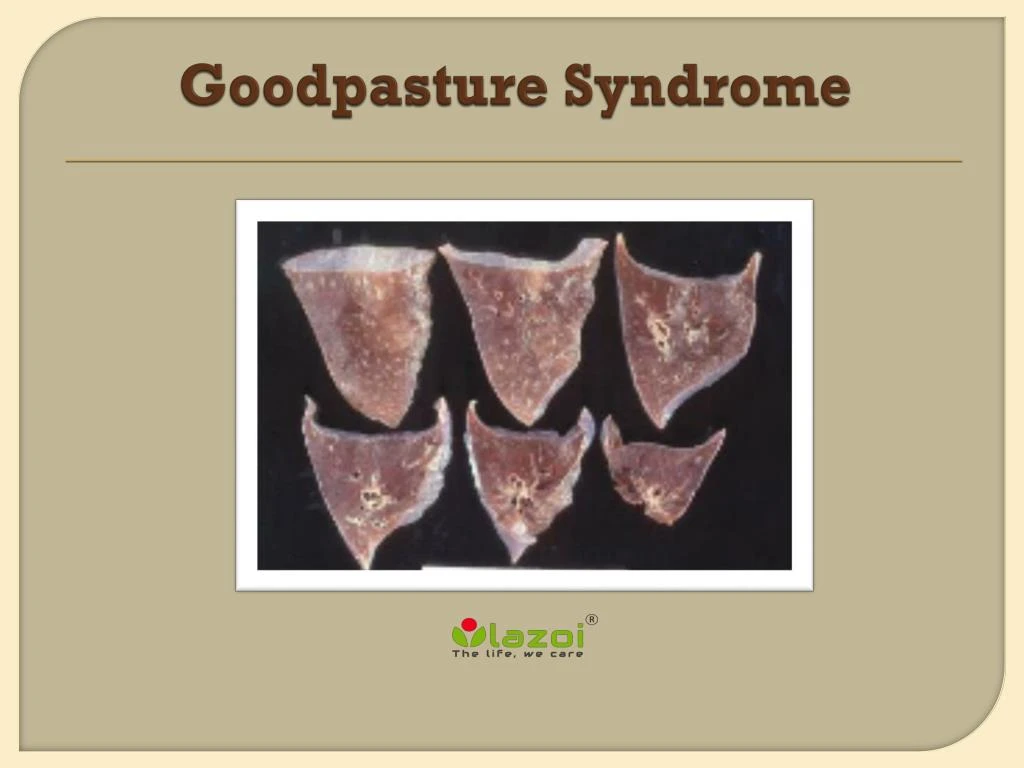 PPT - Goodpasture Syndrome PowerPoint Presentation, free download - ID