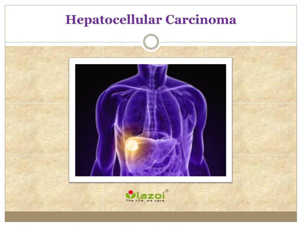 Ppt Hepatocellular Carcinoma Causes Symptoms Daignosis Prevention