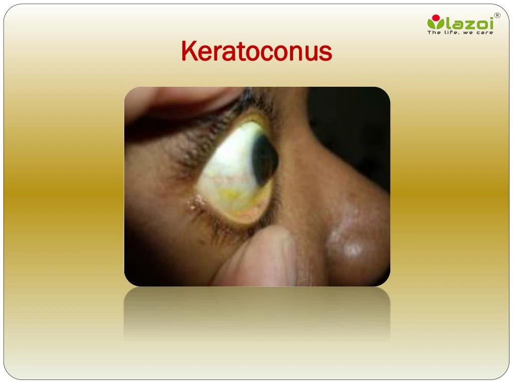 PPT - Keratoconus: Causes, Symptoms, Daignosis, Prevention And ...