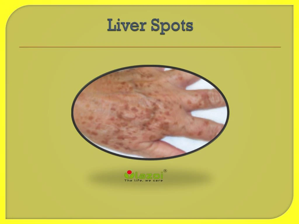 liver-disease-spots-on-skin