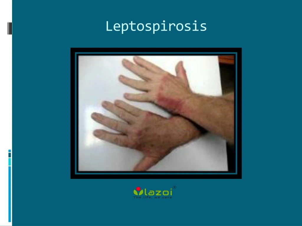 PPT Leptospirosis Causes Symptoms Daignosis Prevention And 