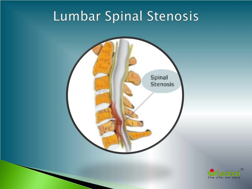 PPT - Lumbar Spinal Stenosis: Causes, Symptoms, Daignosis, Prevention ...