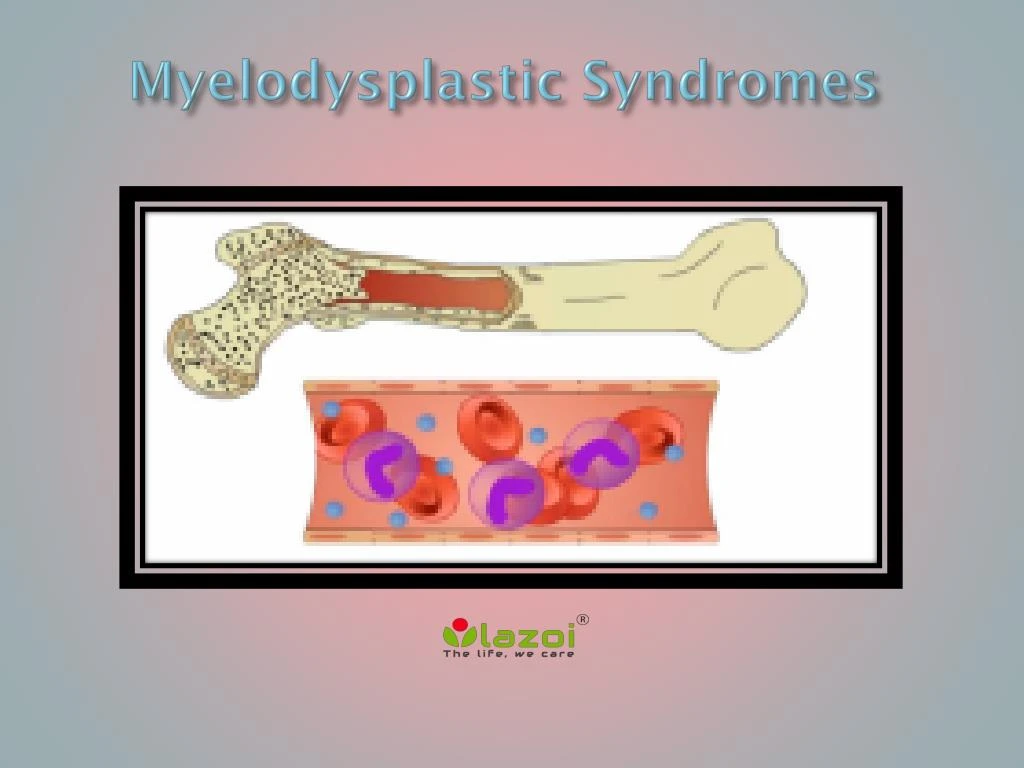 PPT - Myelodysplastic Syndromes: Causes, Symptoms, Daignosis ...