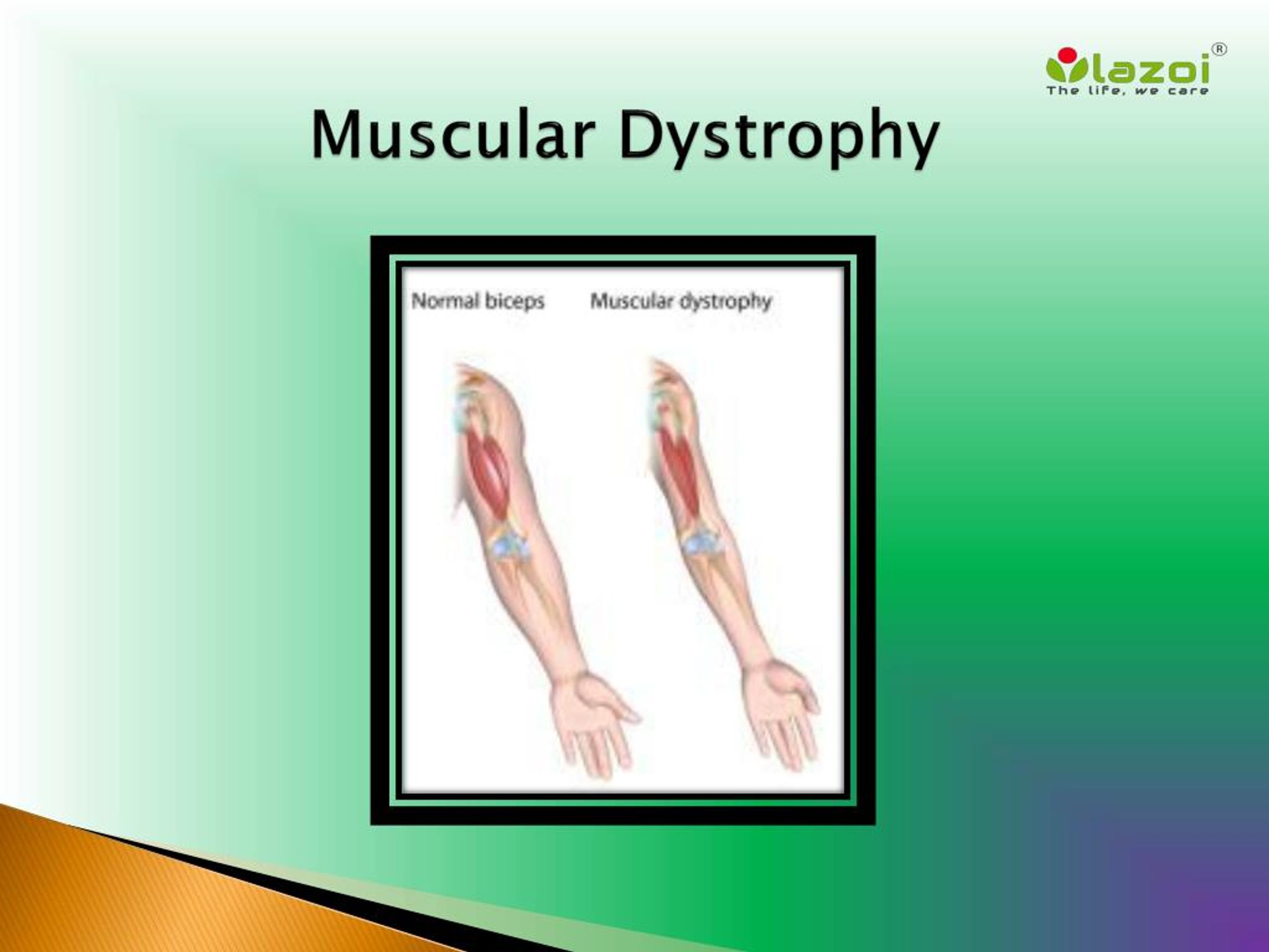 Muscular dystrophy