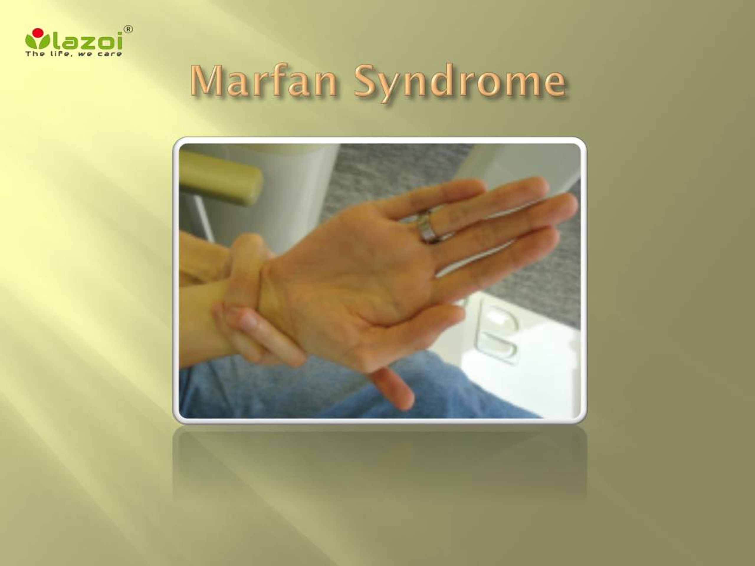 PPT - Marfan Syndrome: Causes, Symptoms, Daignosis, Prevention and ...