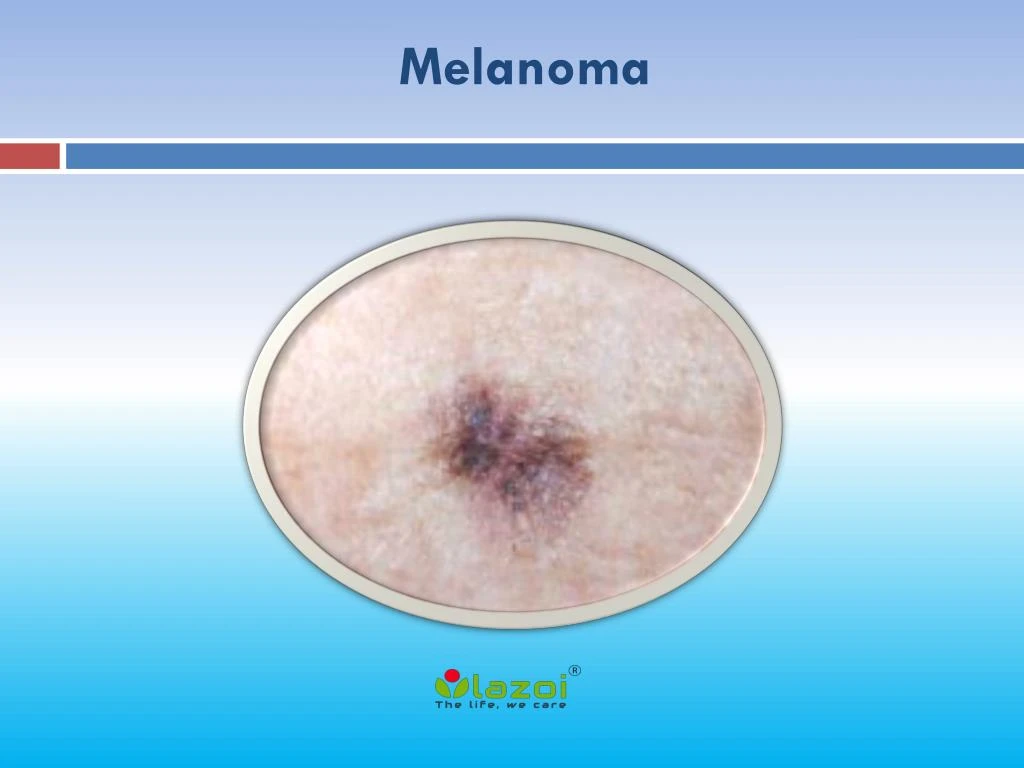 Ppt Melanoma Causes Symptoms Daignosis Prevention And Treatment Melanoma Is The Most 4623