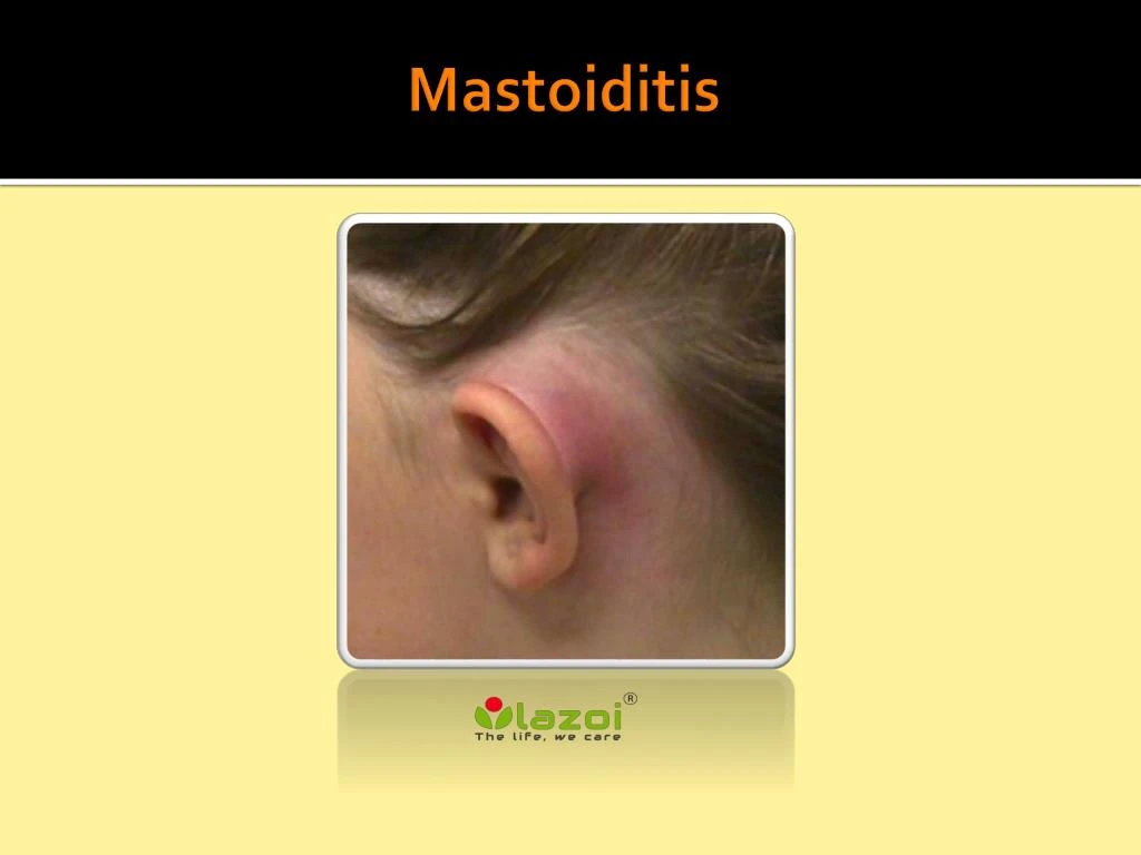 Ppt Mastoiditis Causes Symptoms Daignosis Prevention And | Sexiz Pix