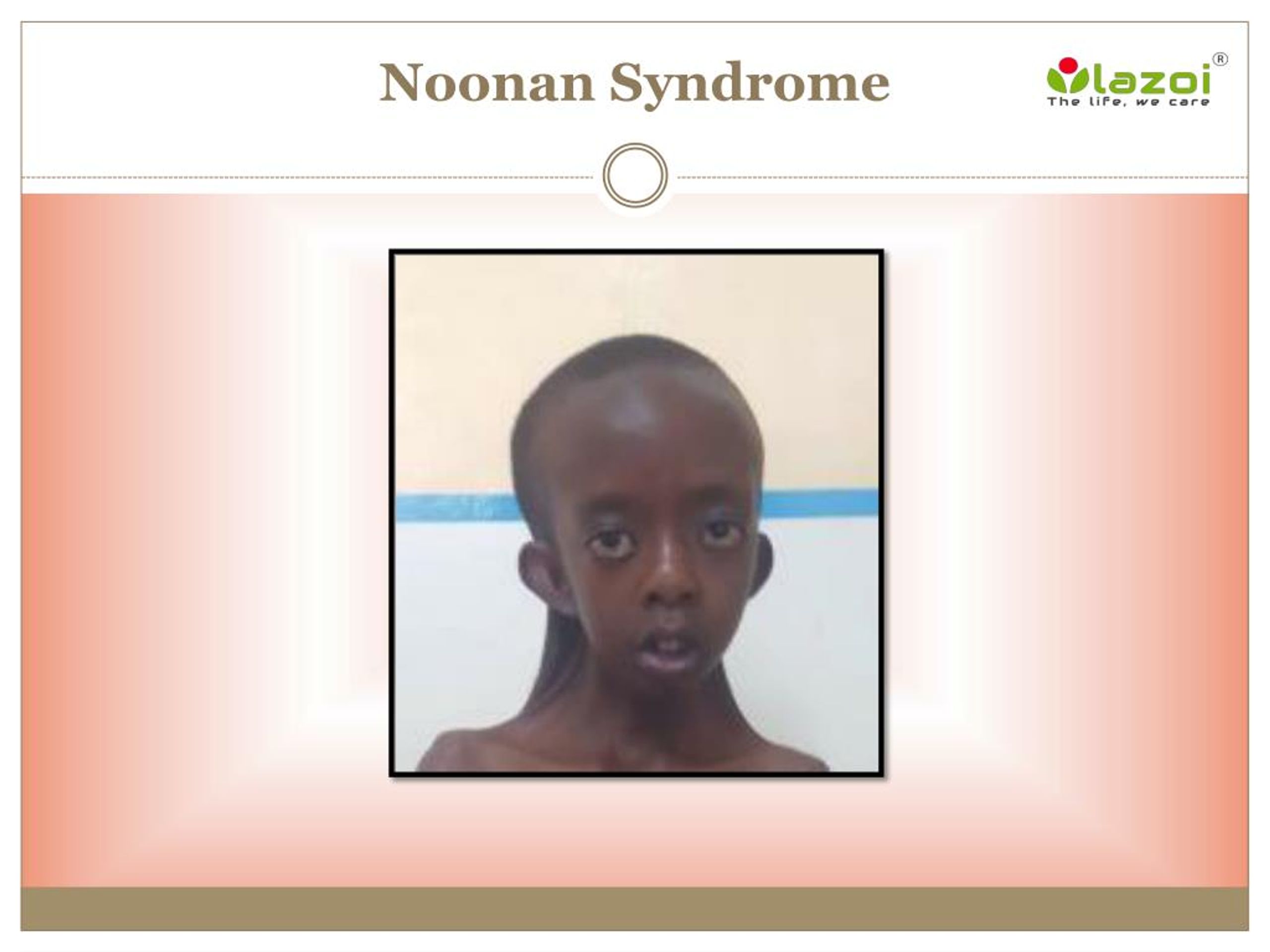 noonan syndrome chromosome