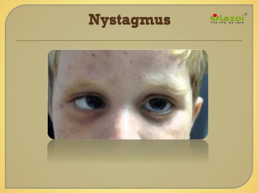 Eye Nystagmus Causes Types Signs Symptoms Test Nystagmus Treatment Vrogue