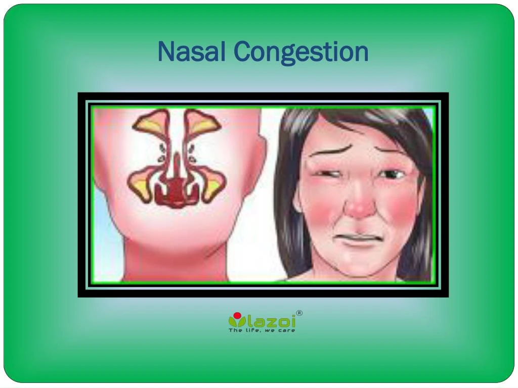 PPT Nasal Congestion Causes, Symptoms, Diagnosis and