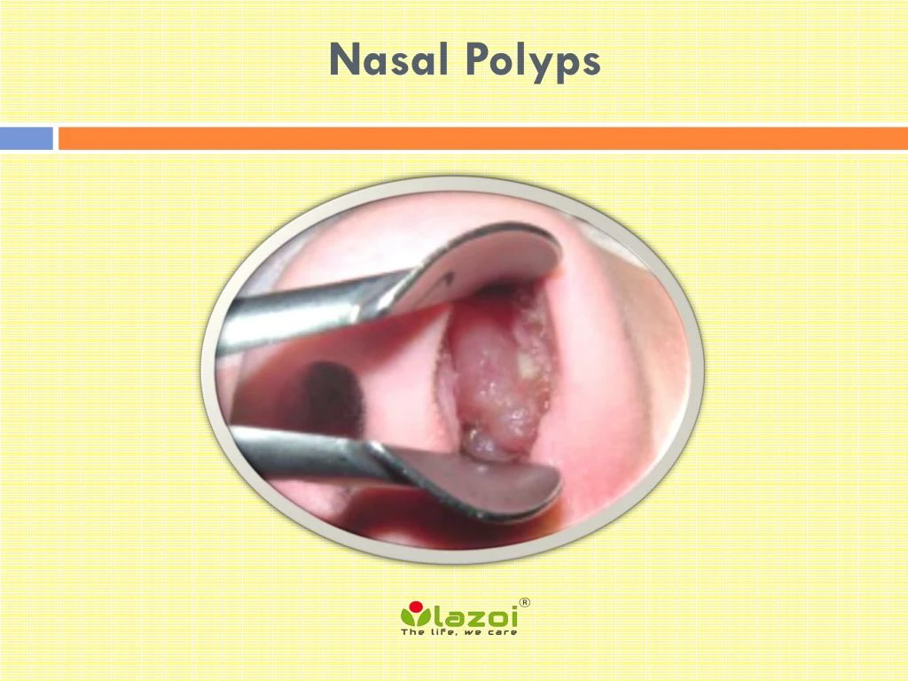 nasal polyps n.