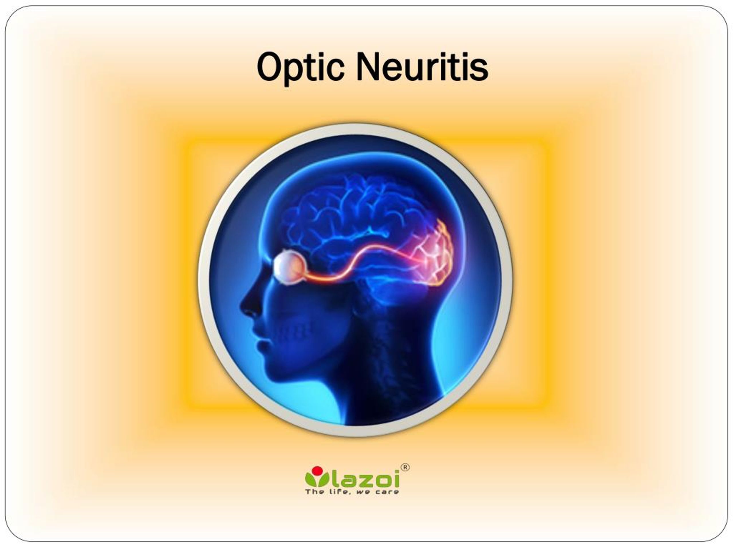 ppt-optic-neuritis-learn-about-the-symptoms-causes-and-treatment