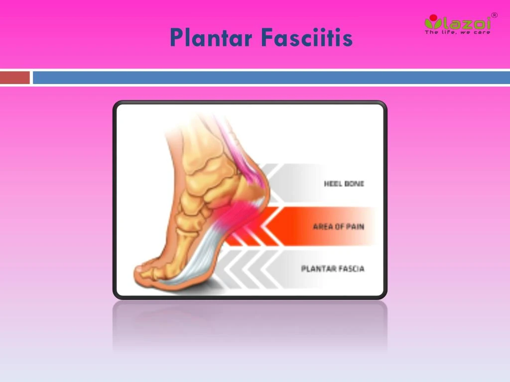 PPT - Plantar Fasciitis: Causes, Symptoms, Daignosis, Prevention and ...