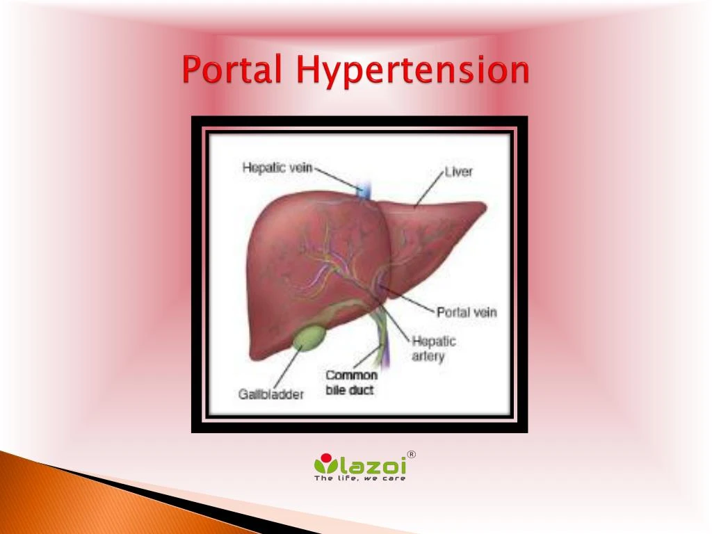 most common presentation of portal hypertension