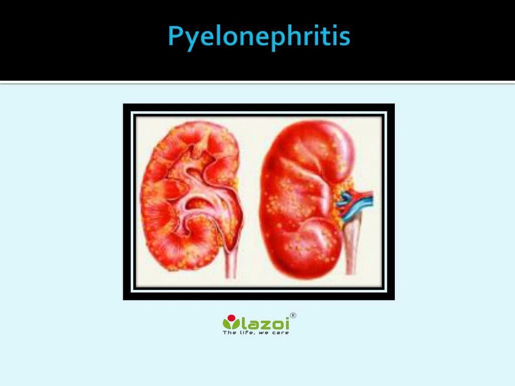 What Is The Meaning Of Pyelonephritis