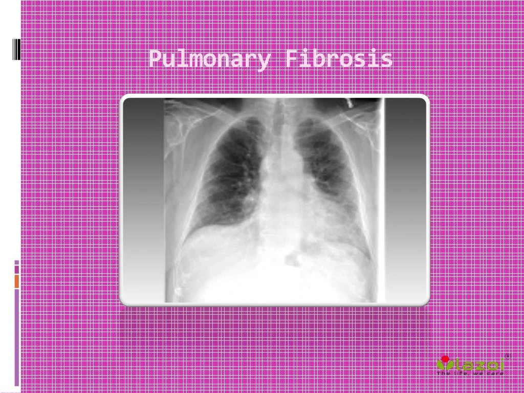 PPT Pulmonary Fibrosis Prognosis, Symptoms, Treatment