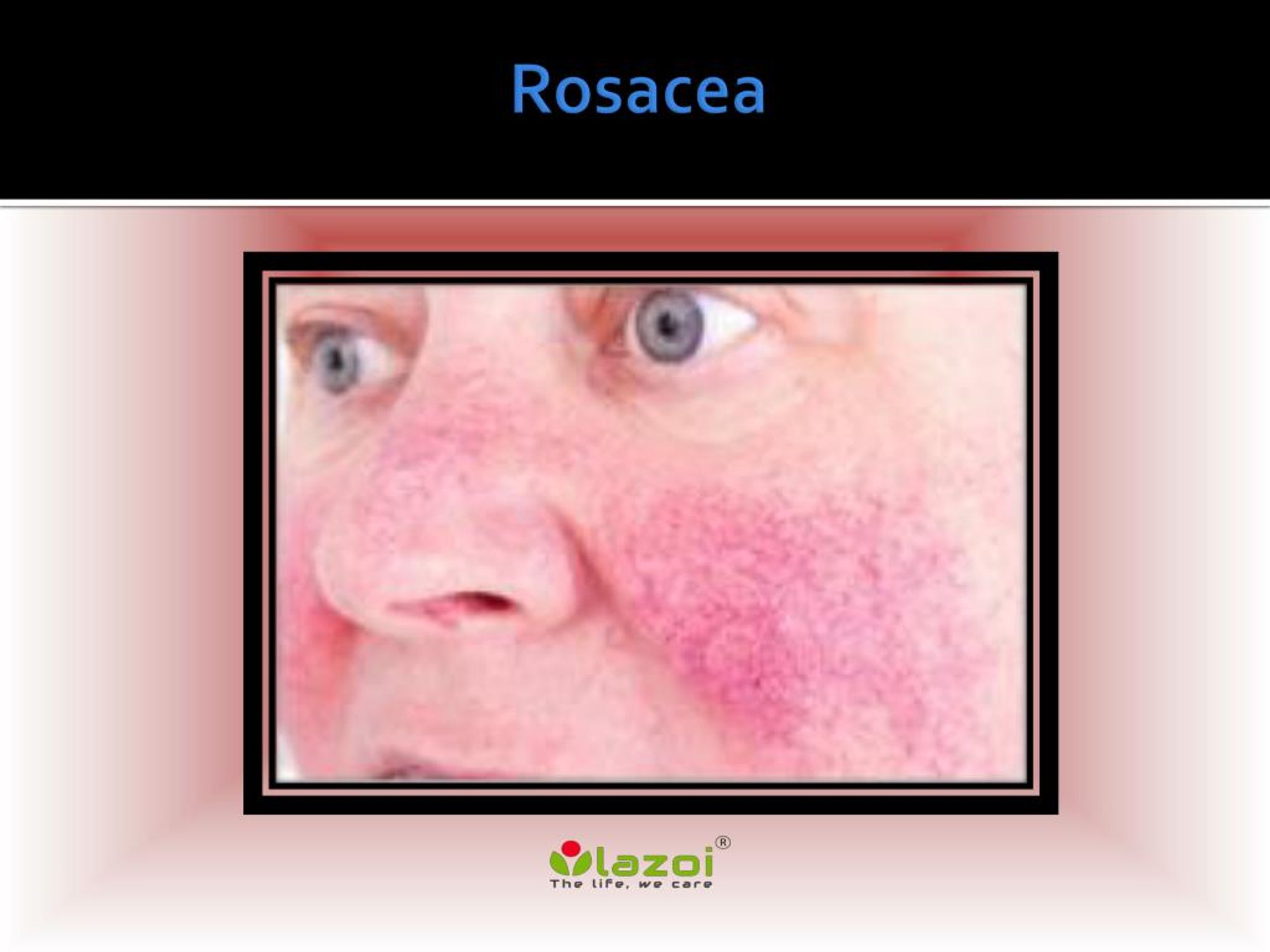 Ppt Rosacea Causes Symptoms Daignosis Prevention And Treatment