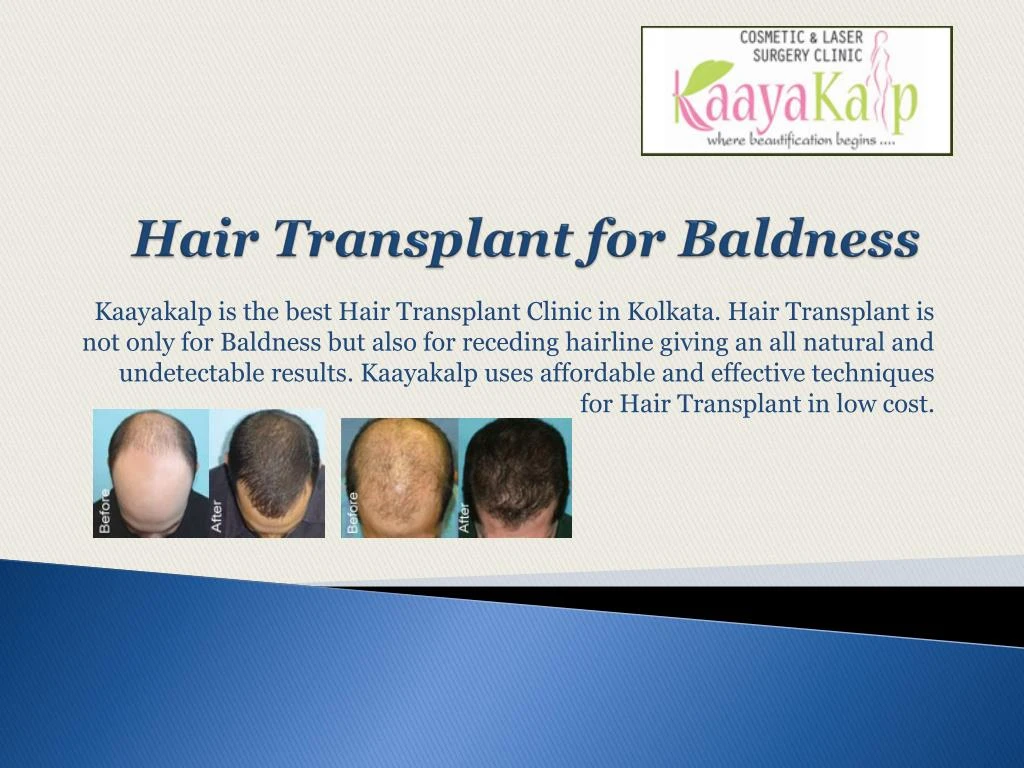 hair transplant for baldness n.