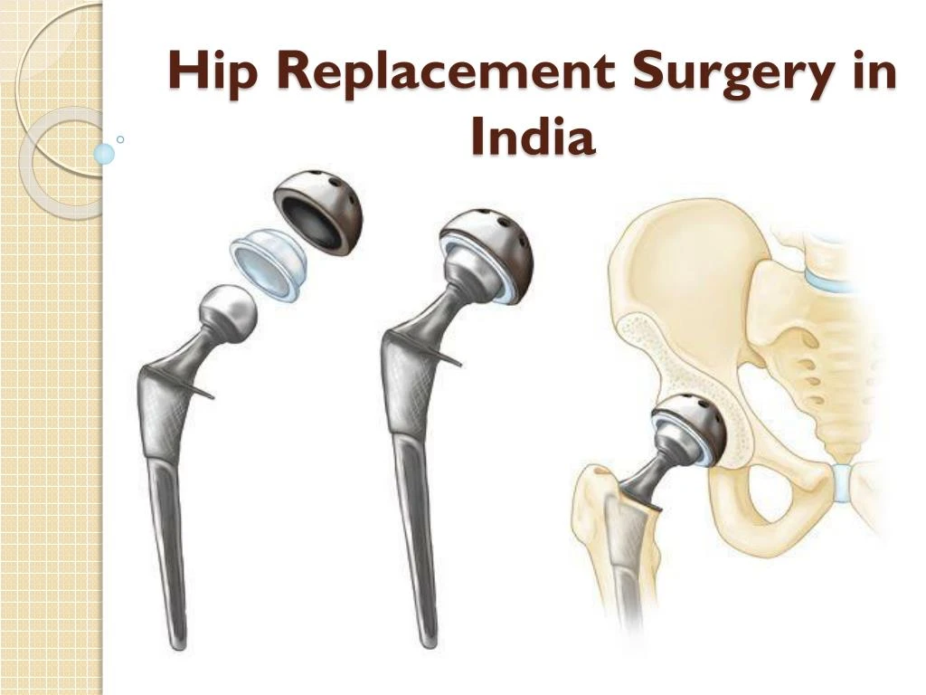 PPT - Cost of hip replacement Surgery in India PowerPoint Presentation ...