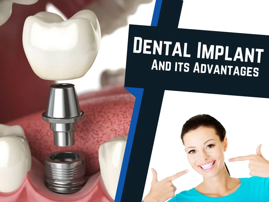 PPT - Advantages of Dental Implants Procedure PowerPoint Presentation ...