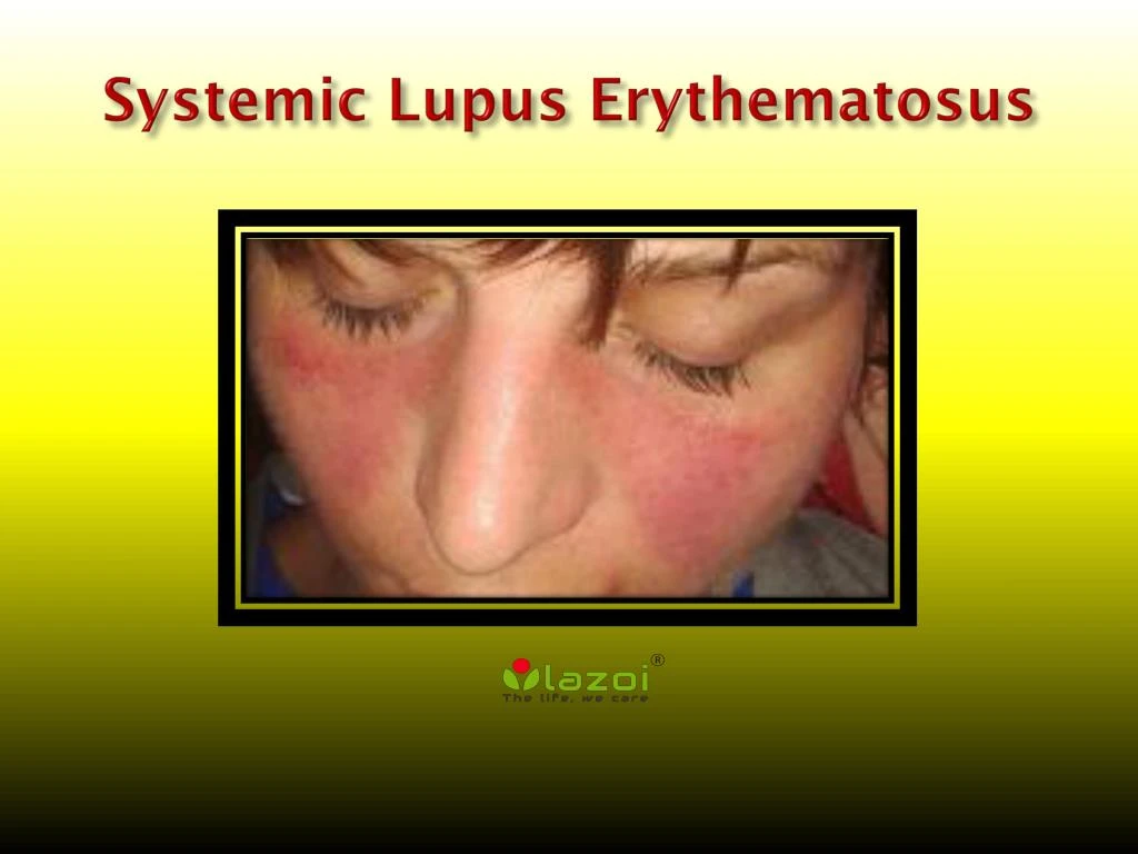 PPT - Systemic Lupus Erythematosus: Causes, Symptoms, Daignosis ...