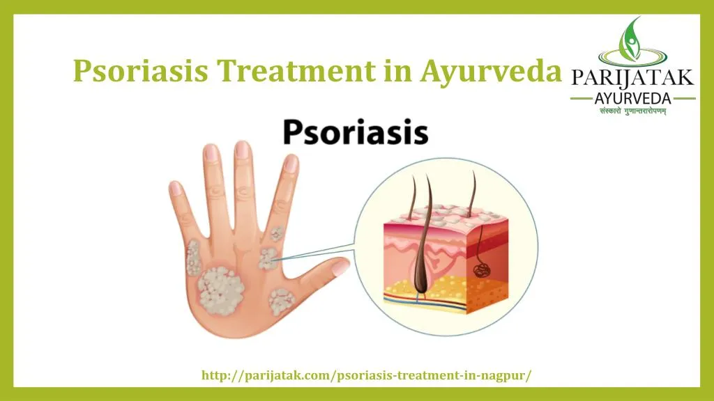 psoriasis treatment in ayurveda n.