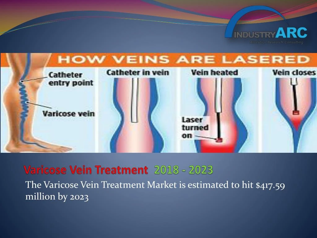 varicose vein treatment 2018 2023 n.