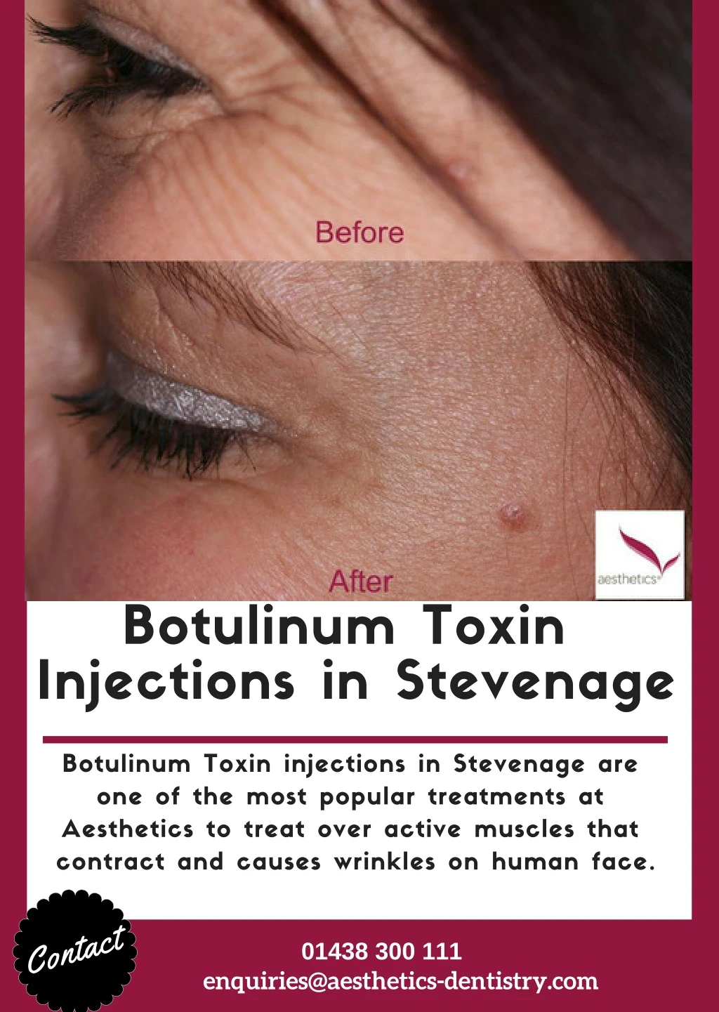 botulinum toxin injections in stevenage n.