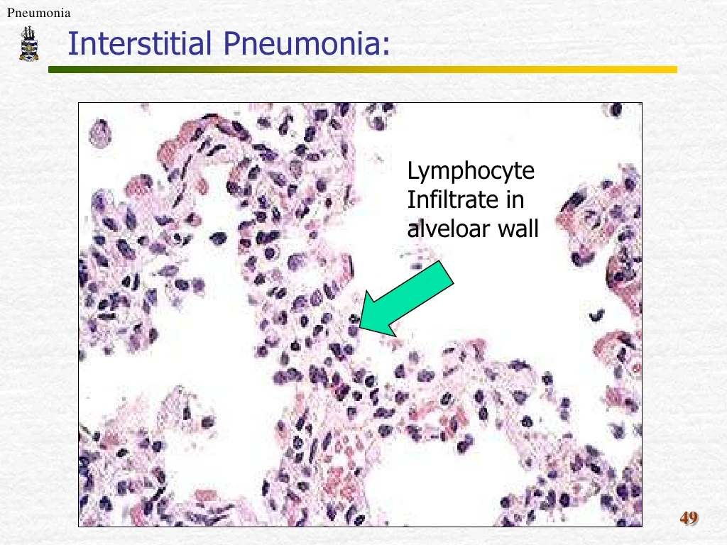 PPT - Pathology Of Pneumonia PowerPoint Presentation - ID:8201860