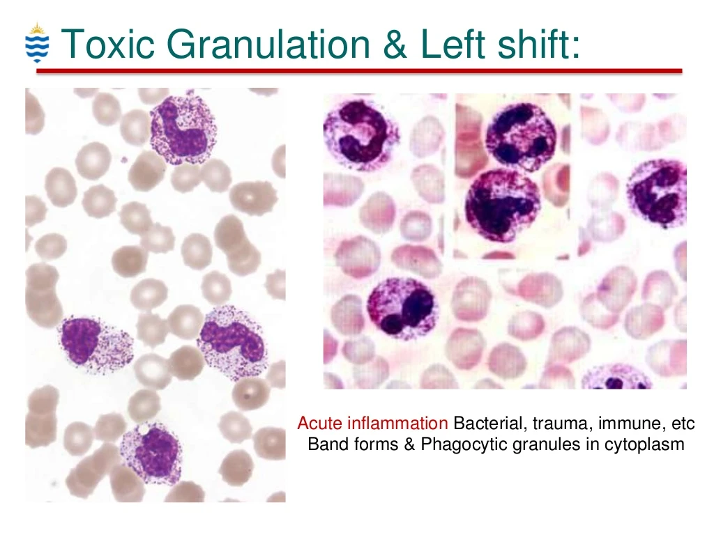 left shifted granulocytes