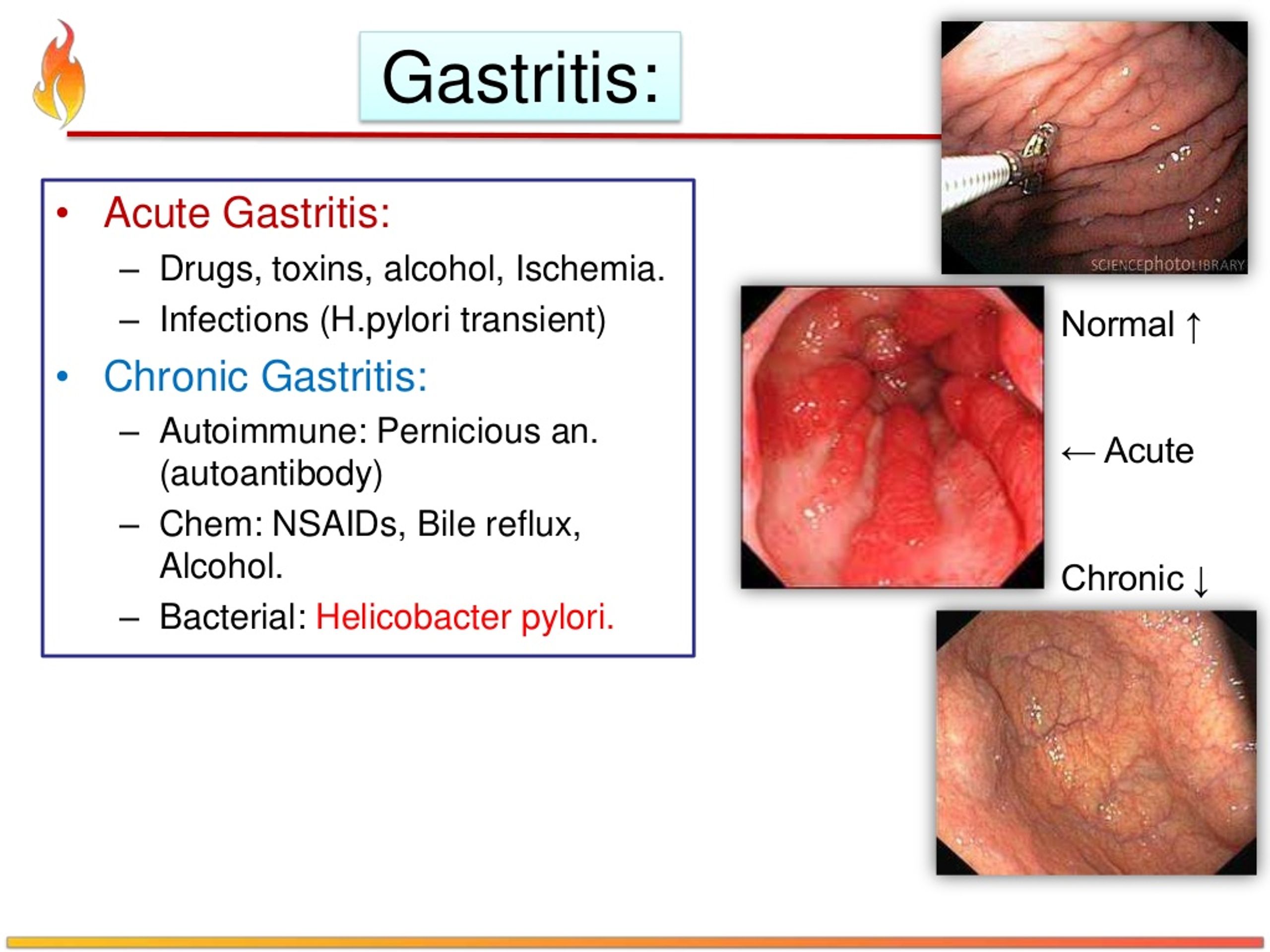 Infusiones para la gastritis