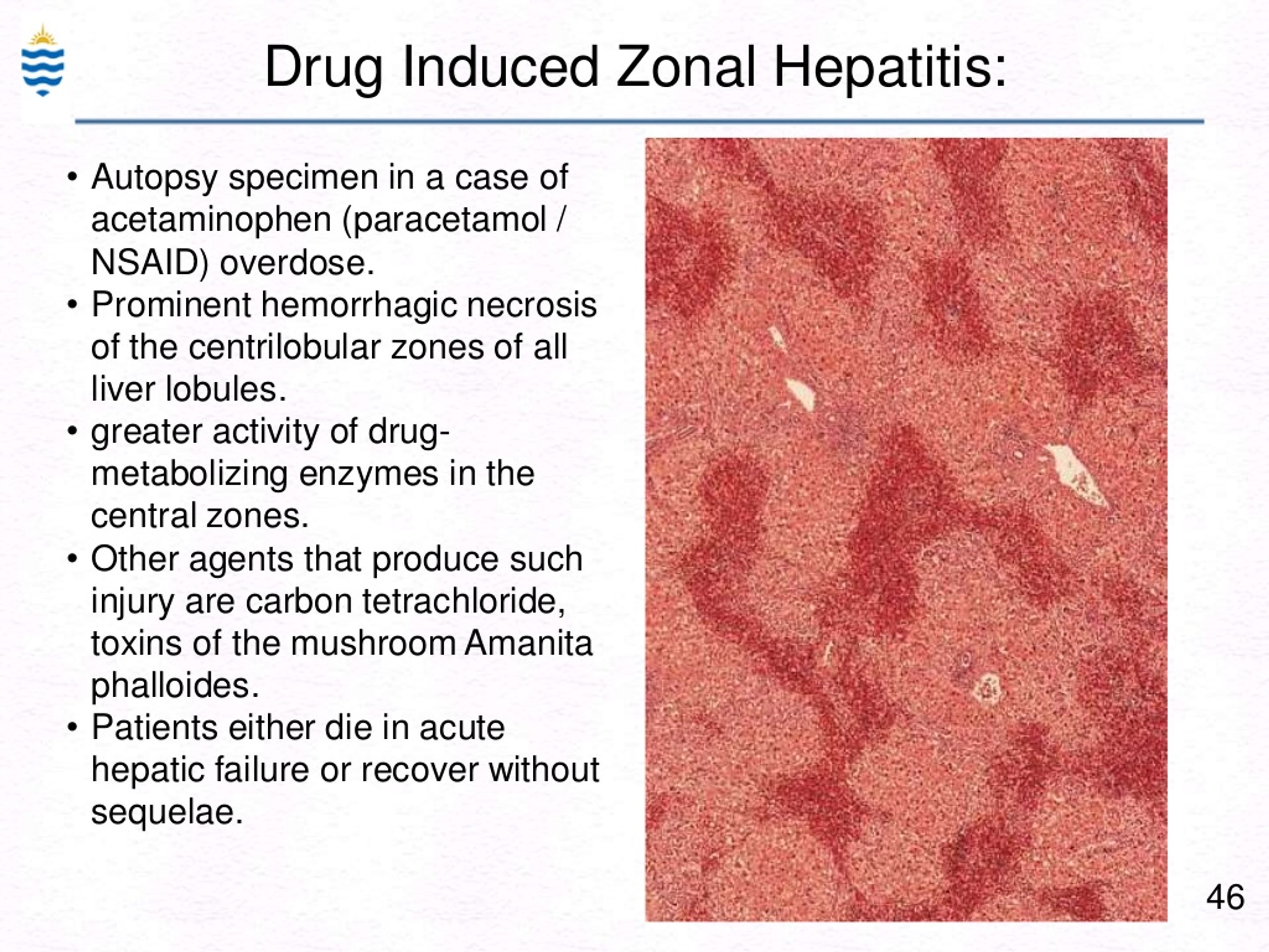 Ppt Pathology Of Hepatitis Lecture Powerpoint Presentation Free Download Id