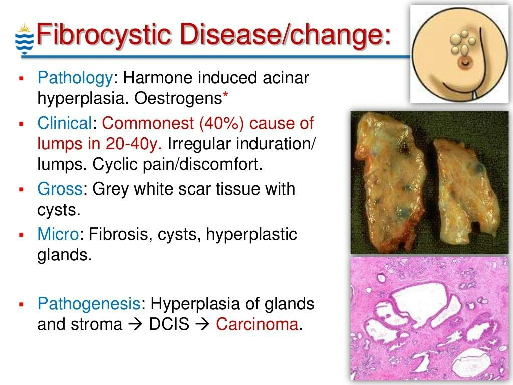 Ppt Breast Pathology Lecture 2013 Powerpoint Presentation Id 8201940