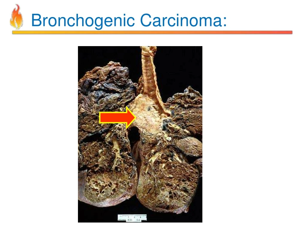 Ppt Pathology Of Copd Powerpoint Presentation Id8201945