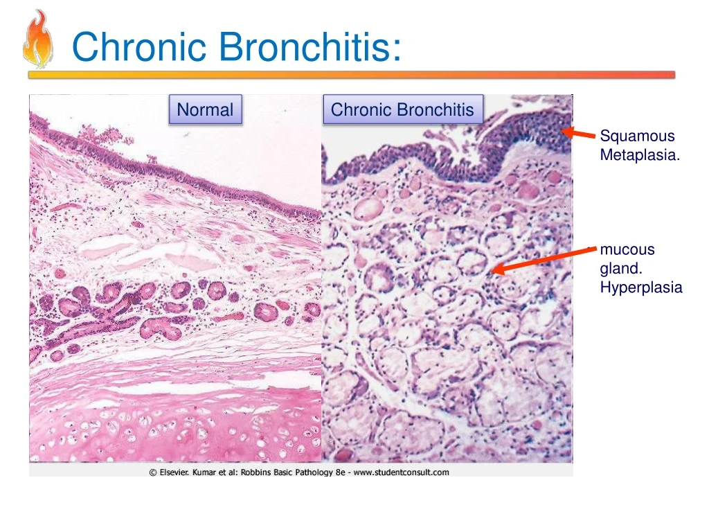 Ppt Pathology Of Copd Powerpoint Presentation Id 8201945