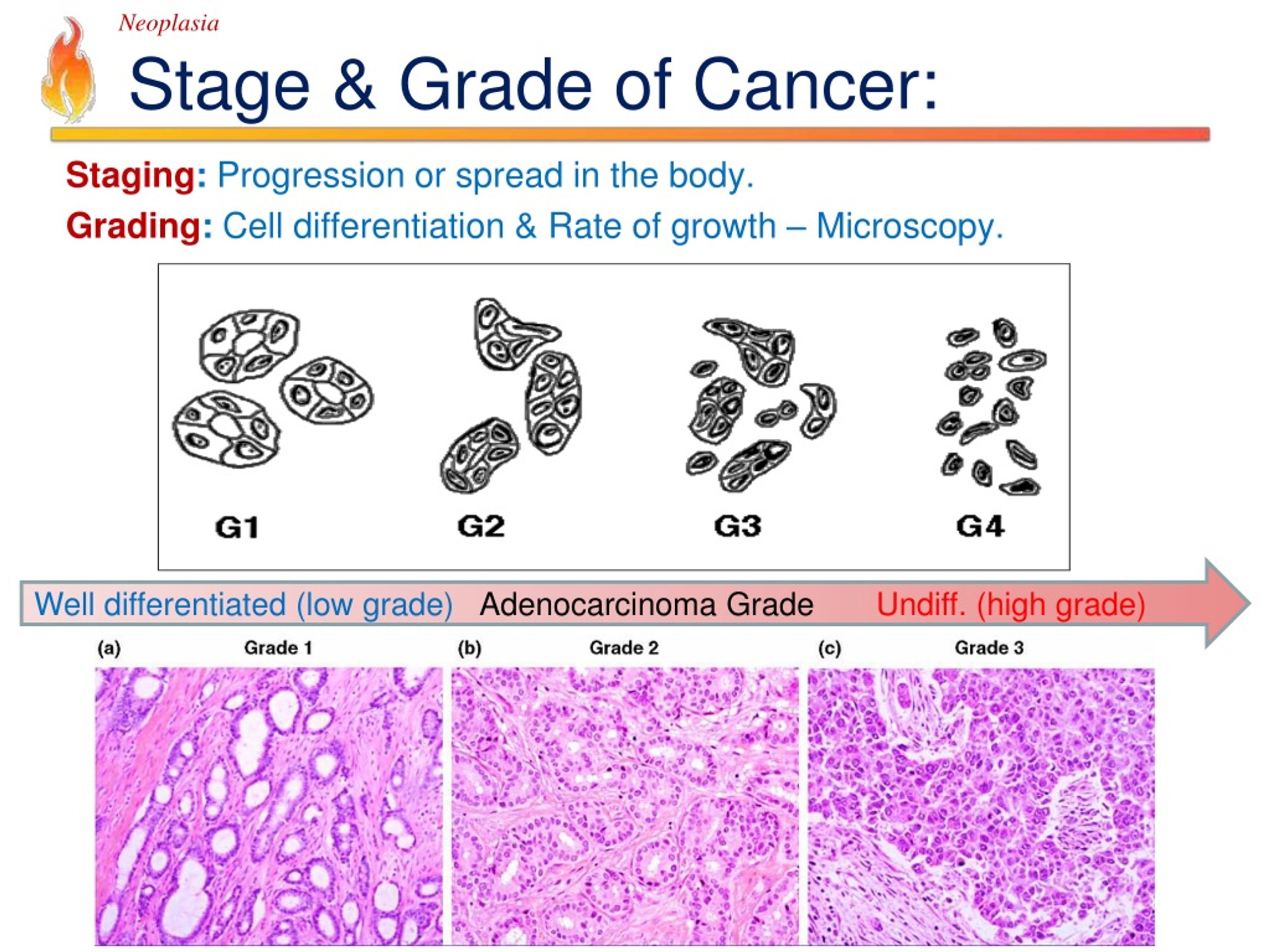 Stages of cancer. Неоплазия lo v Grade. Gleason классификация.