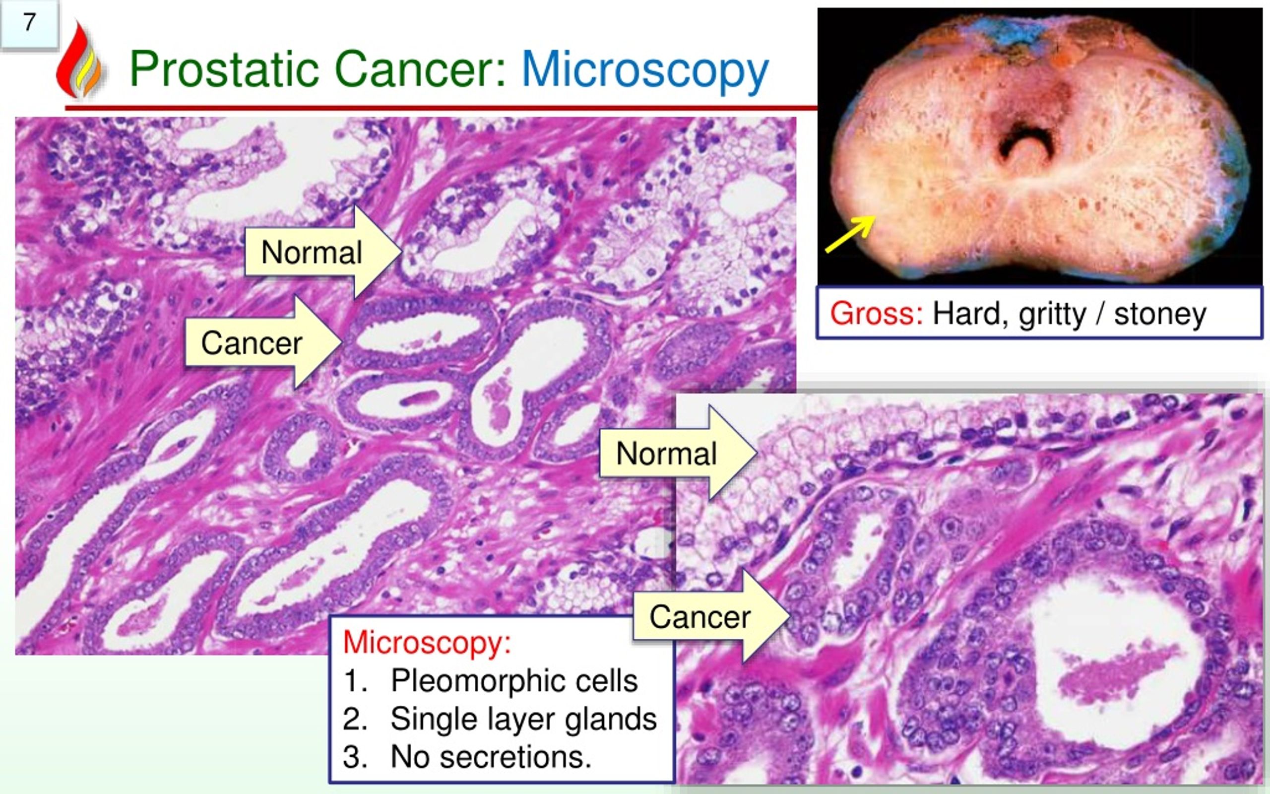 Is Ice Cream Good For Prostate Cancer at lisacnguyens blog