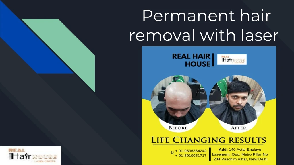 permanent hair removal with laser n.