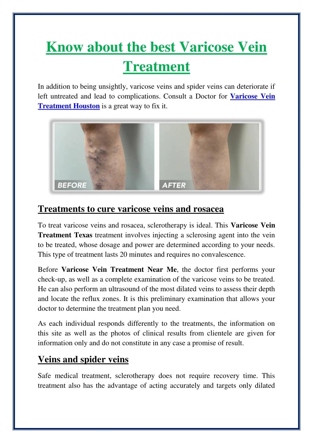 know about the best varicose vein treatment n.