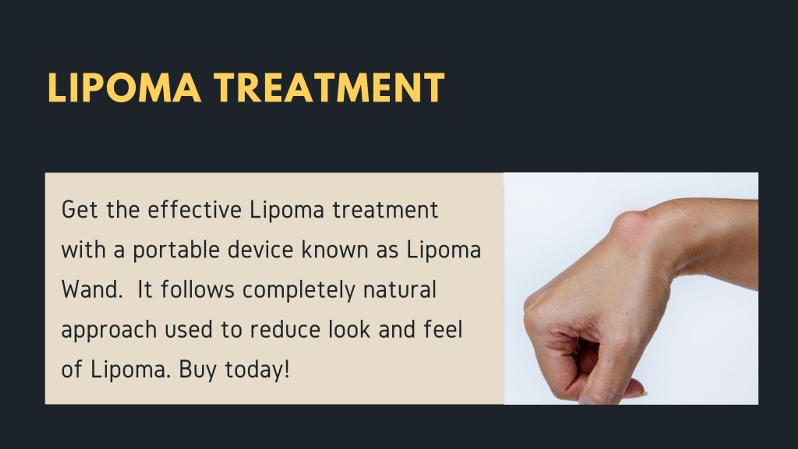 PPT - Lipoma Removal - Lipoma Wand PowerPoint Presentation, free ...