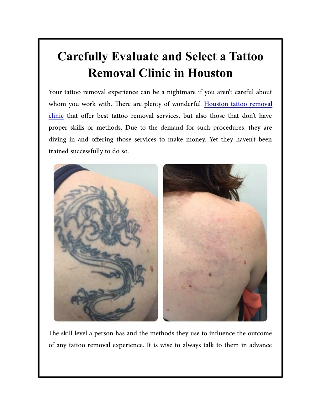 carefully evaluate and select a tattoo removal n.
