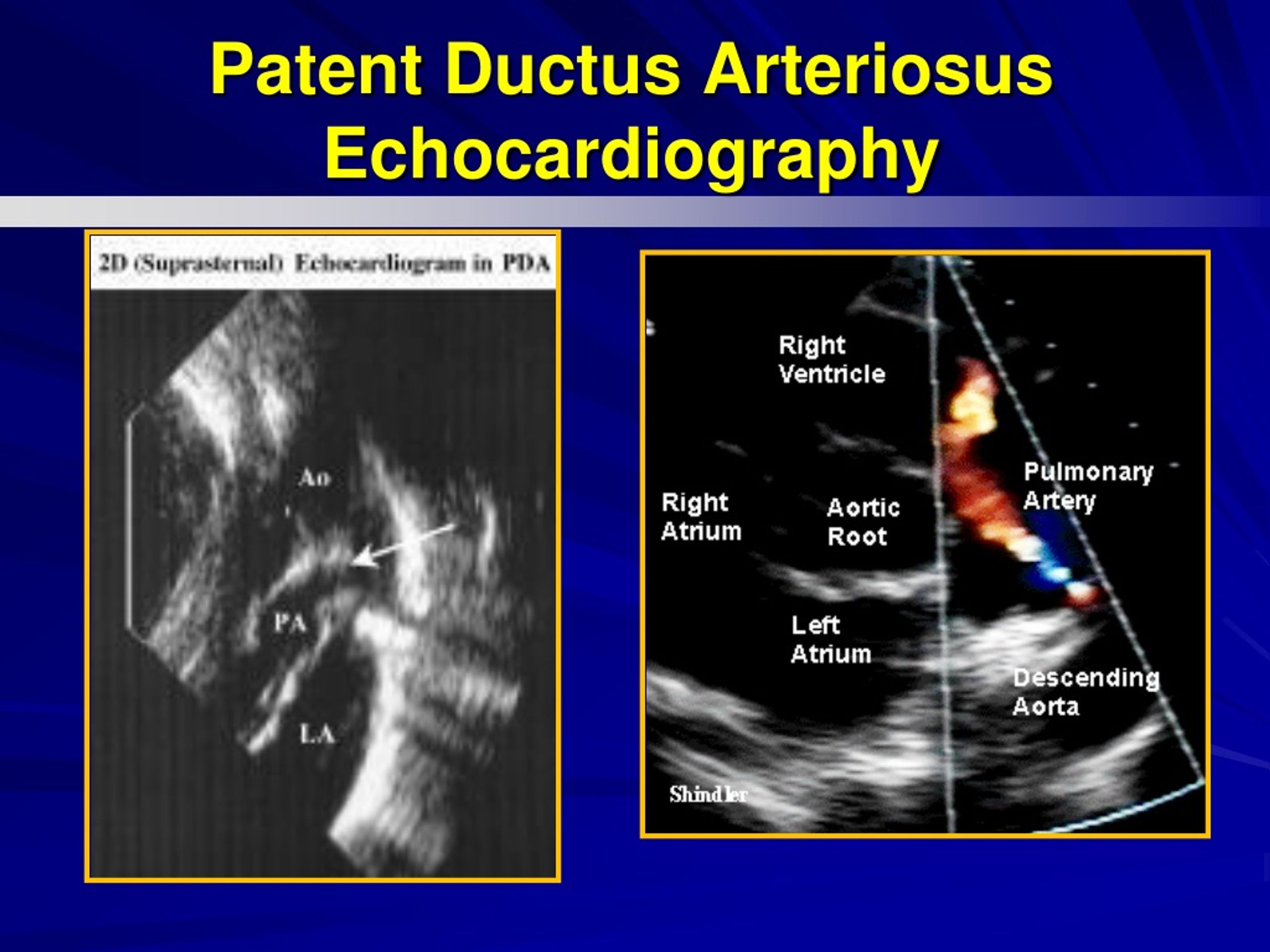 Patent Ductus Arteriosus Echocardiography