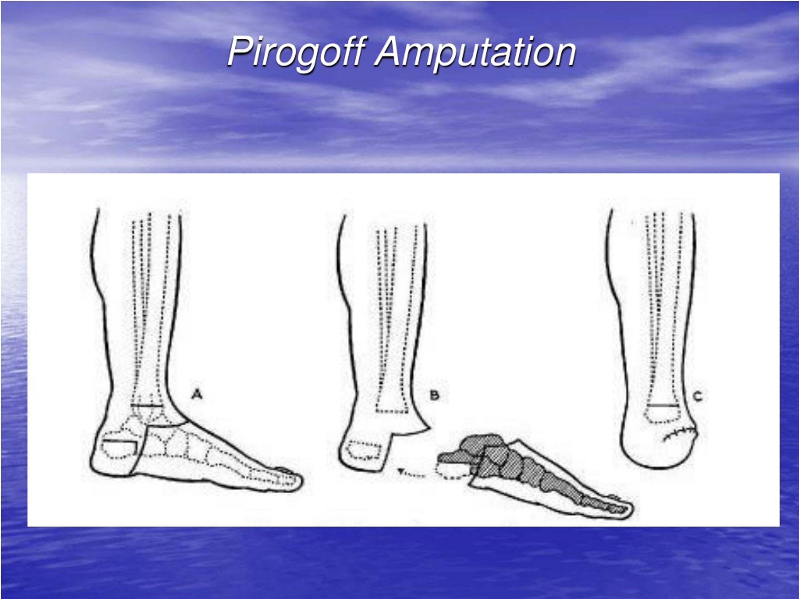 Ppt Basic Surgical Principles Of Amputations And Disarticulations Of The Upper And Lower