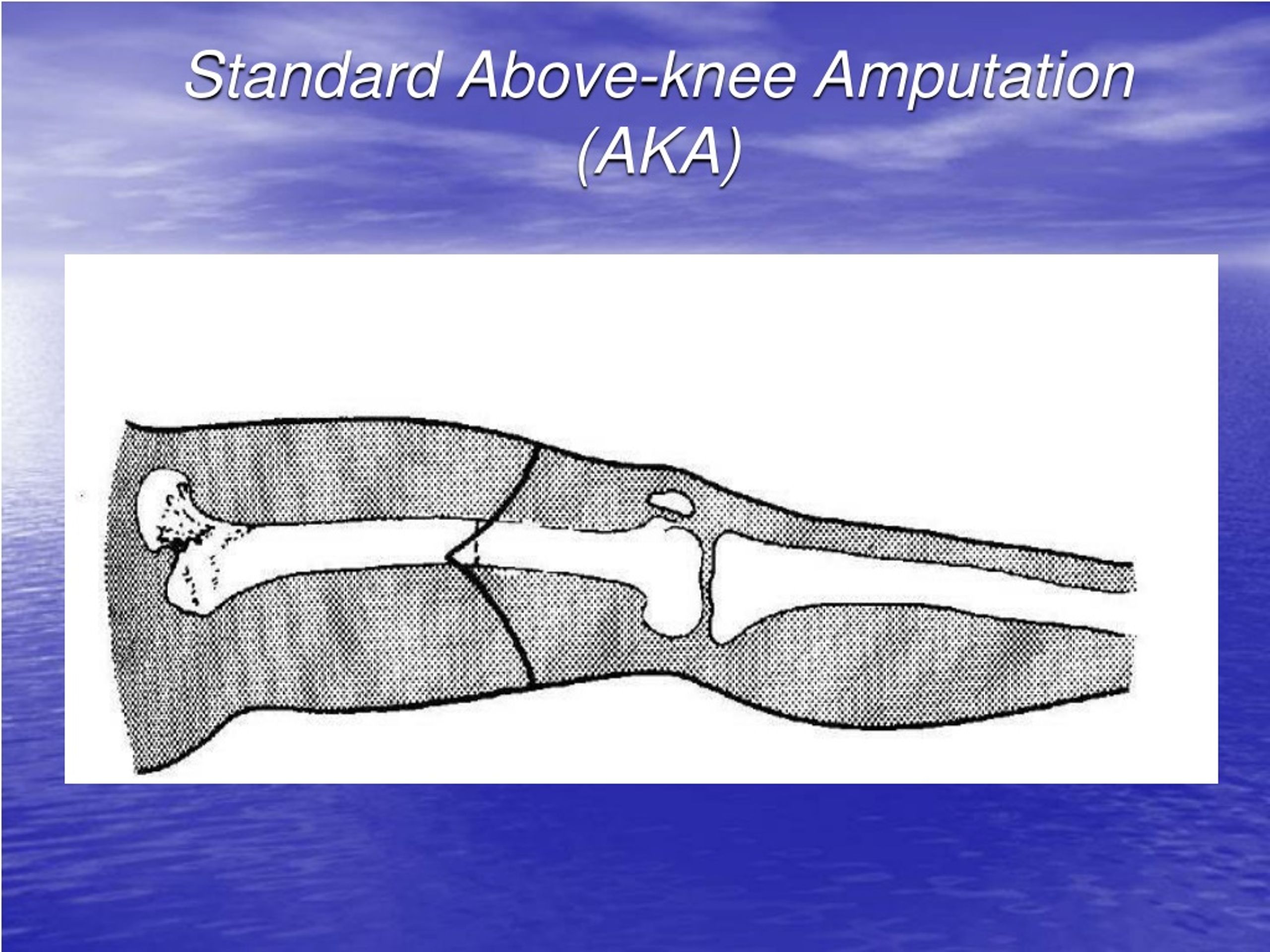 Ppt Basic Surgical Principles Of Amputations And Disarticulations Of The Upper And Lower