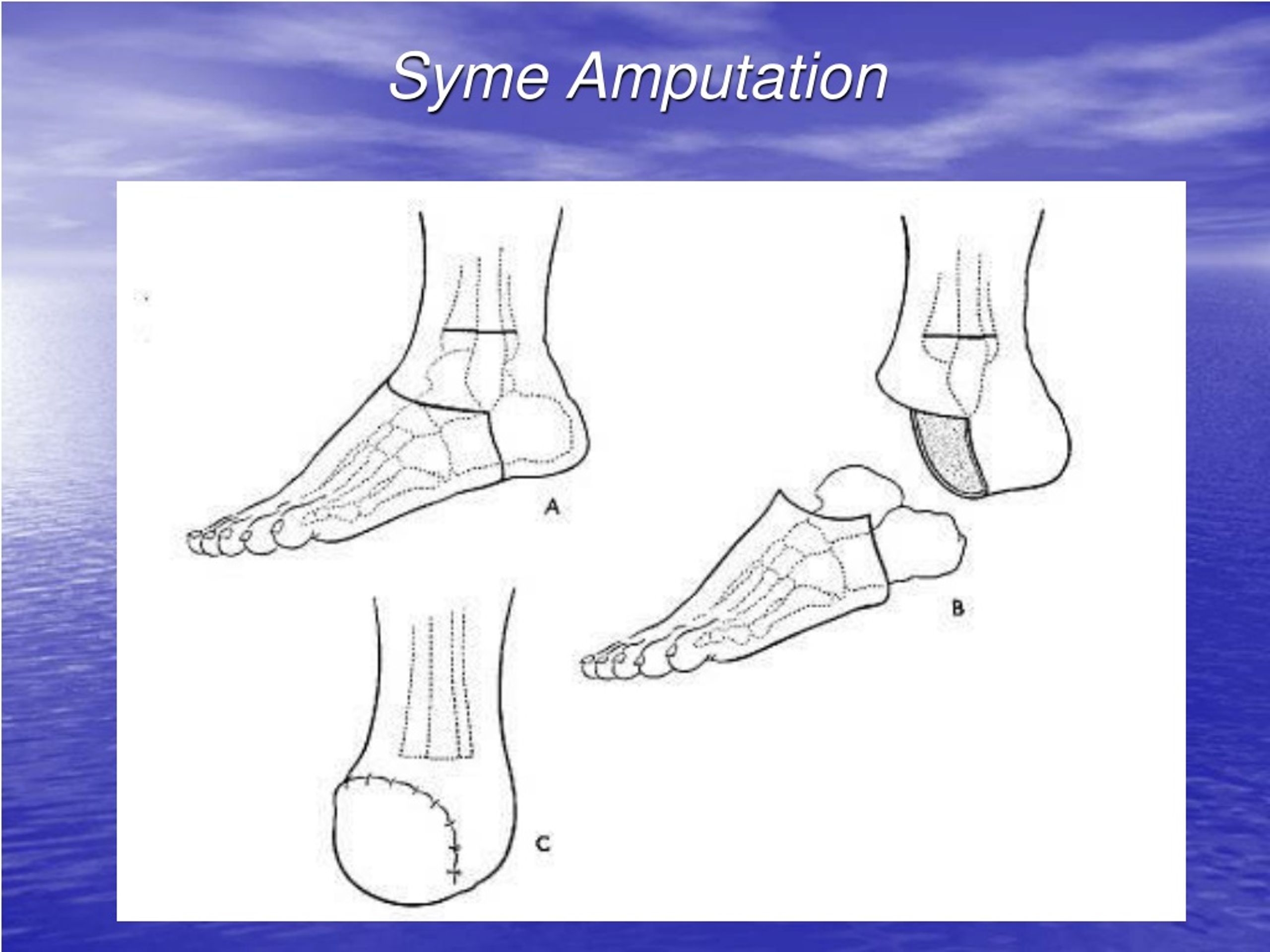 PPT Basic Surgical Principles Of Amputations And Disarticulations Of The Upper And Lower