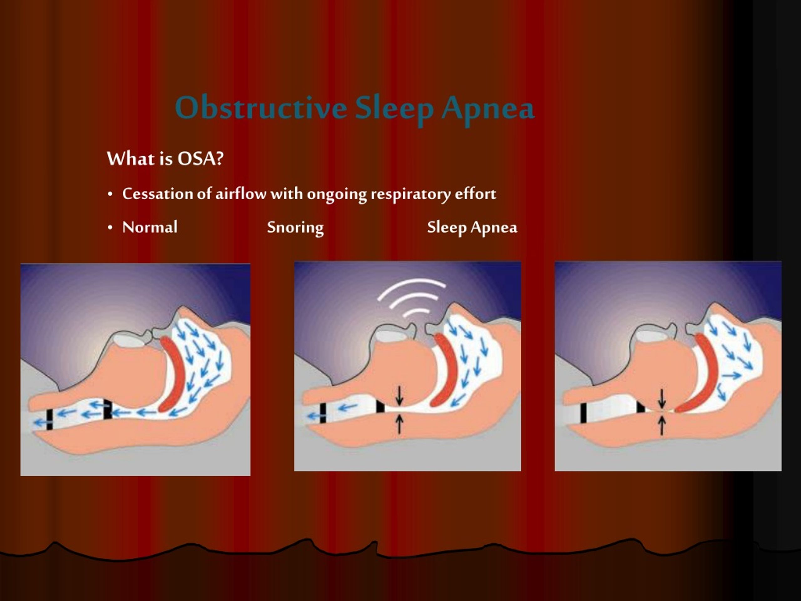 An Overview Of Obstructive Sleep Apnea What Is Osa My Xxx Hot Girl