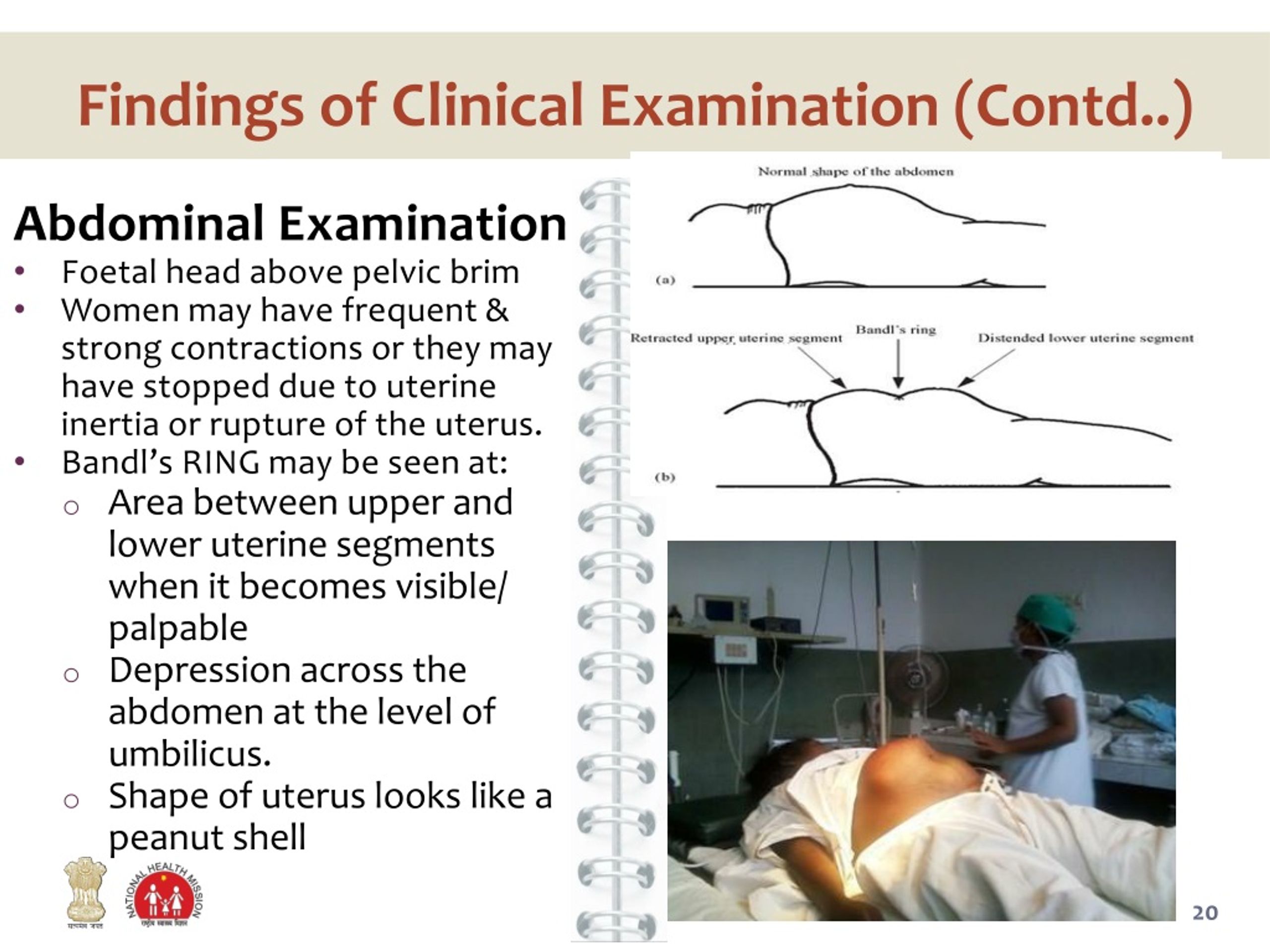 Retraction Ring Leaflet | PDF | Uterus | Childbirth