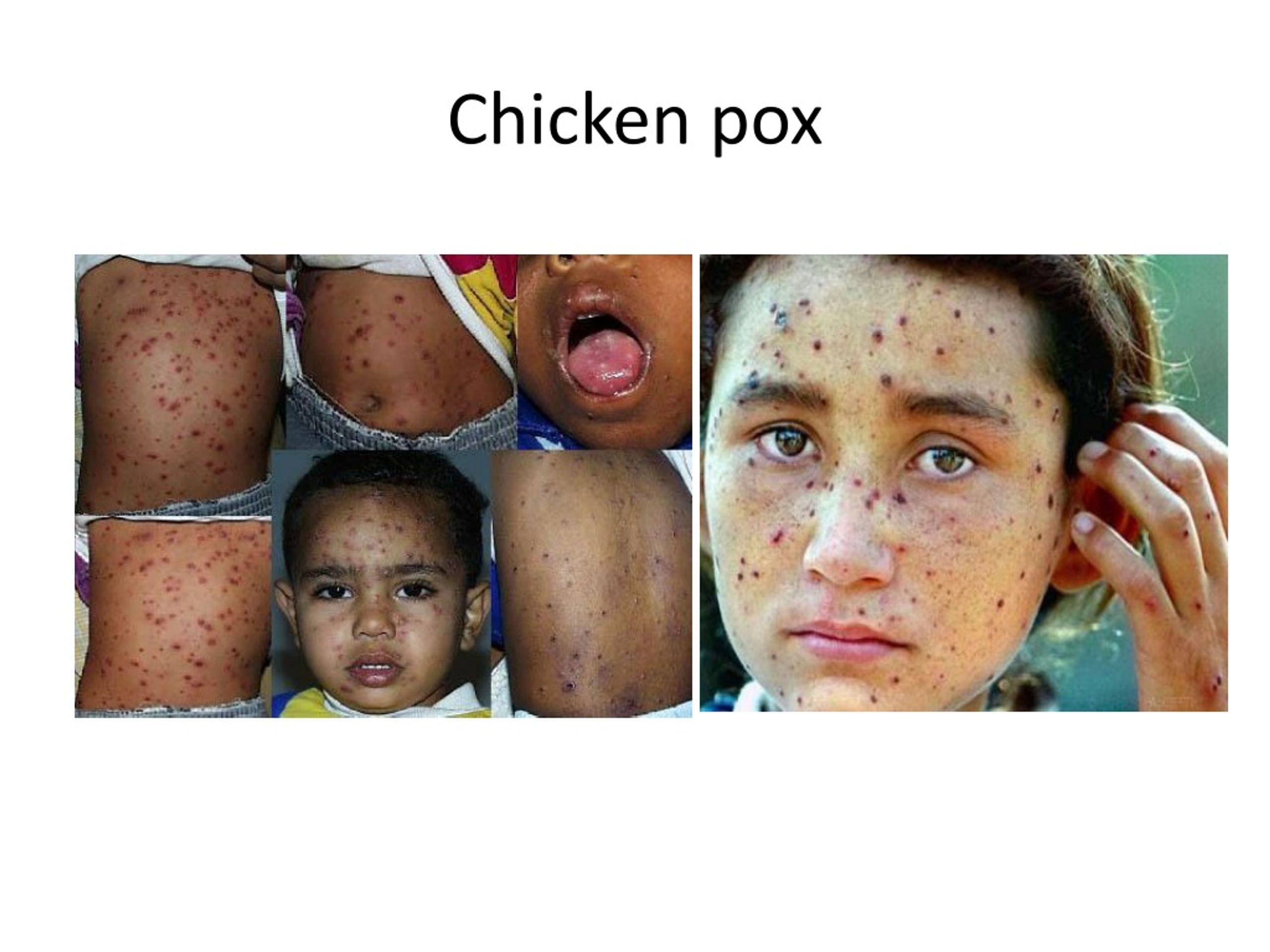 Ppt - Chickenpox And Herpes Zoster Powerpoint Presentation, Free 