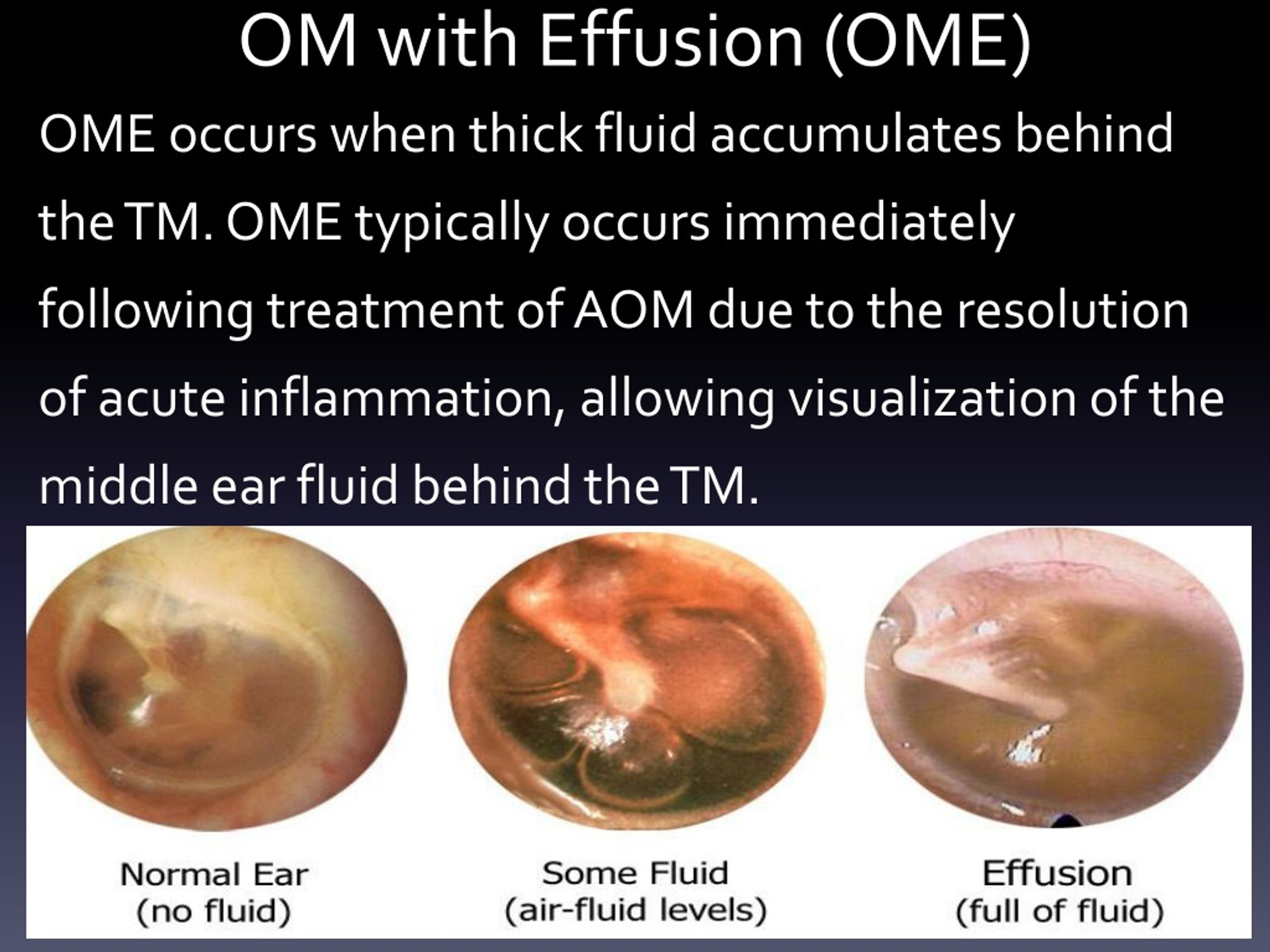 Otitis Media With Effusion Treatment At Edith Erdman Blog